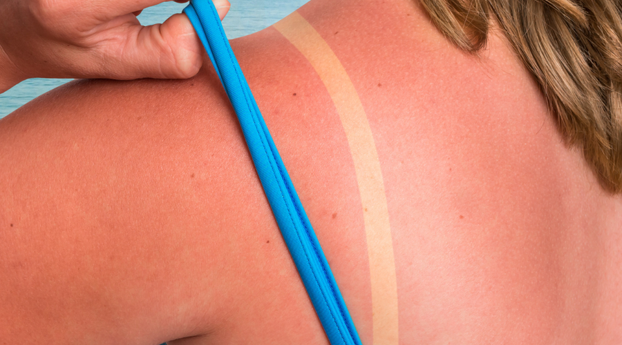 Soothe Sunburn Naturally!